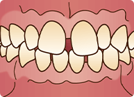 空隙歯列